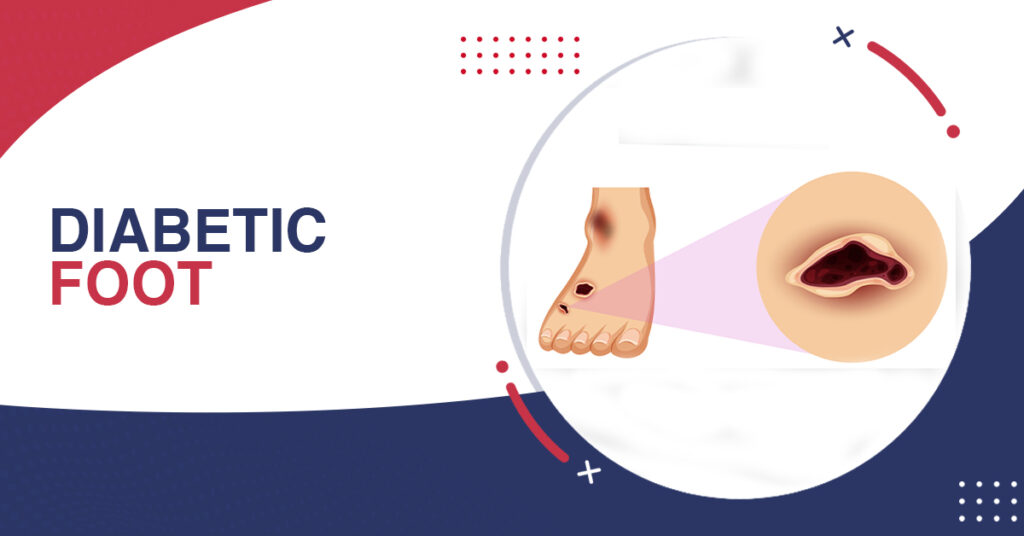 Diabetic Foot Surgery